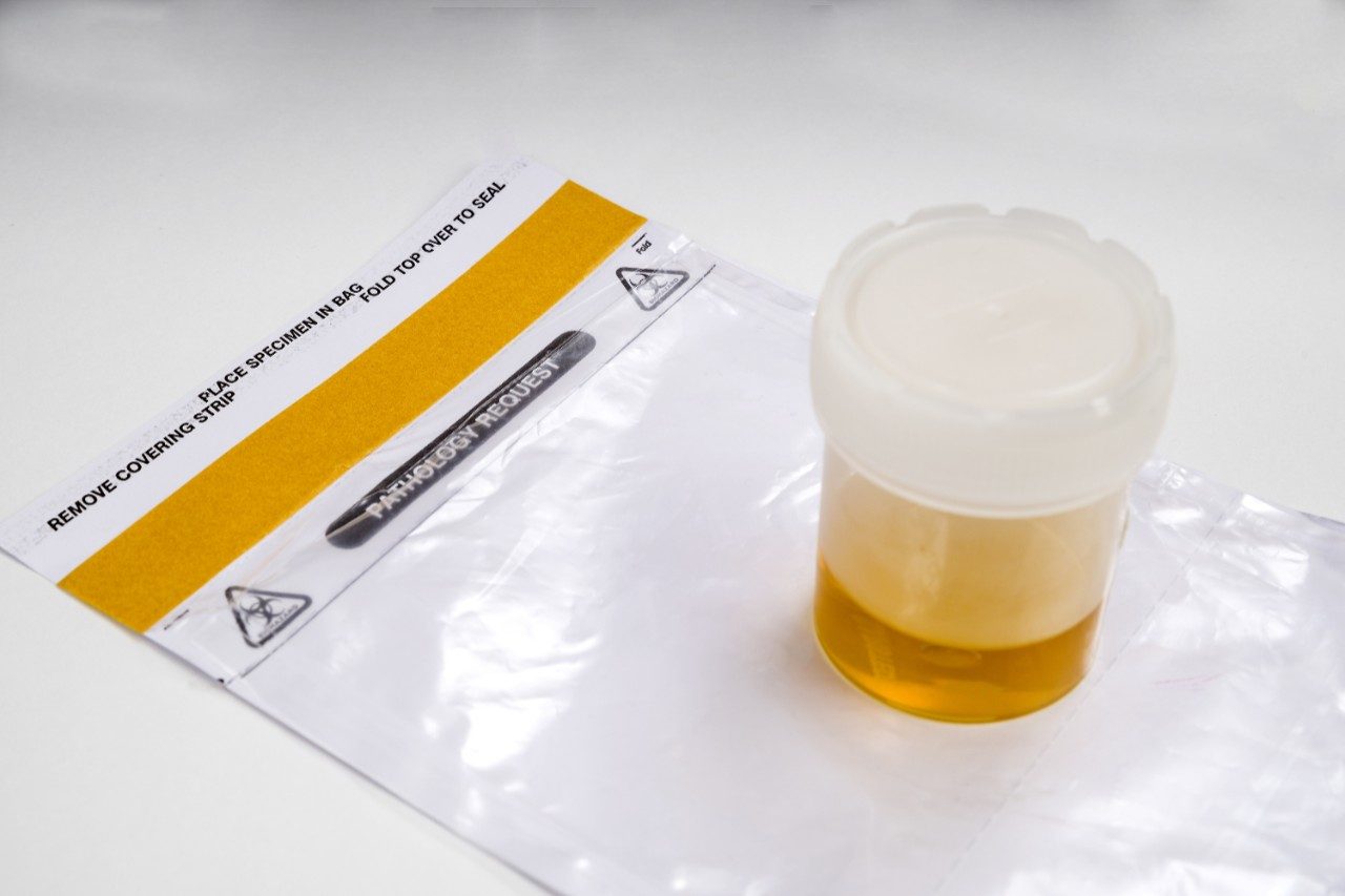 Urine sample in cup on pathology bag