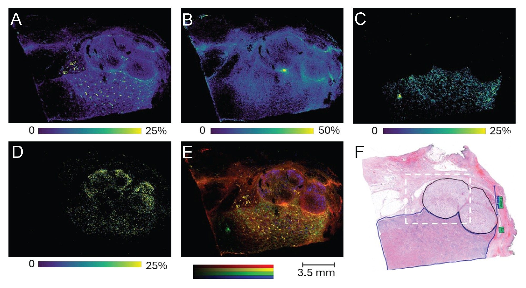 Results of MALDI analysis of stained human ccRCC ISUP grade 3) FFPE section with a 50 µm pixel size