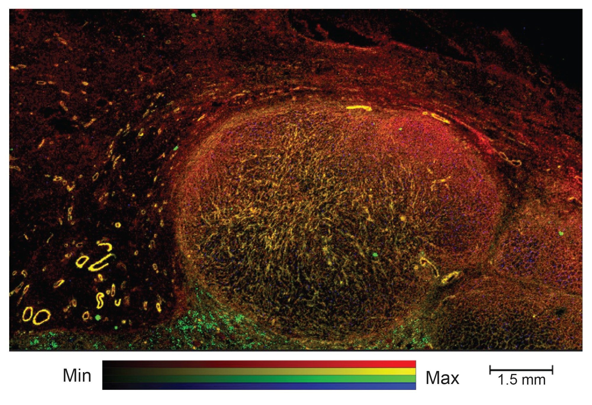 20 µm pixel size image 4 color overlay of the left side tumor lobule, maximum intensity has been scaled for visualization no minimum cut off has been applied, yellow; Actin-aSM, max intensity 25%, red; Vim, max intensity 50%, green; PanCK, max intensity 25%, blue; Ki67, max intensity 10%